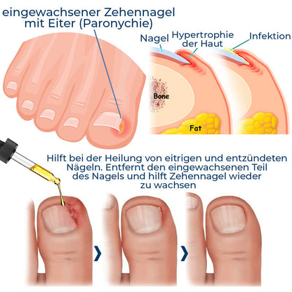 Deutsch ZehennagelPlus™ Anti Paronychia Hilfe Öl