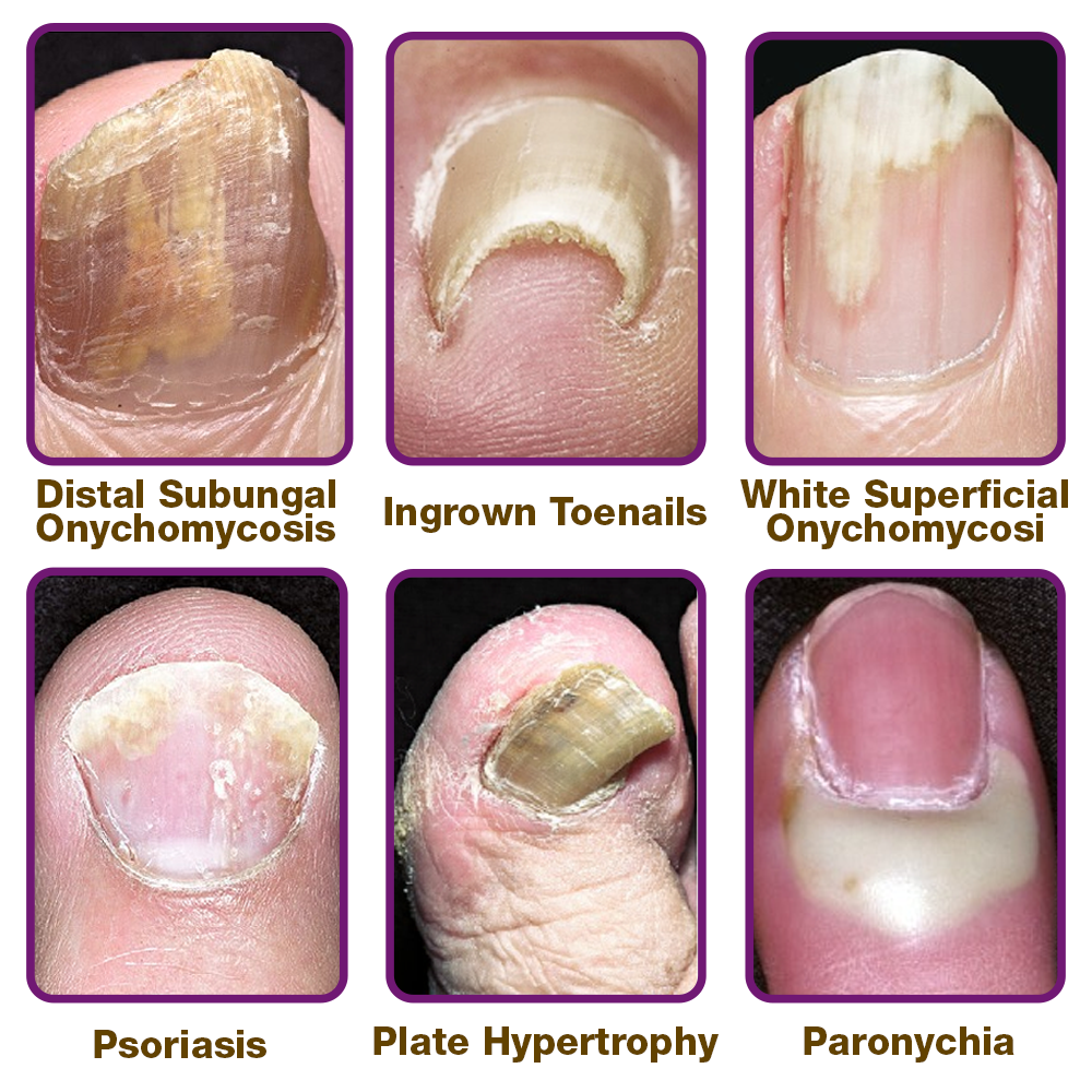 flysmus™ FungiFres Bienengift Nagelbehandlungsserum