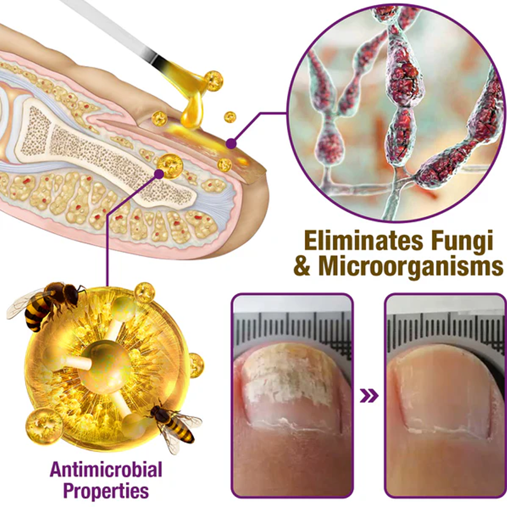 flysmus™ FungiFres Bienengift Nagelbehandlungsserum