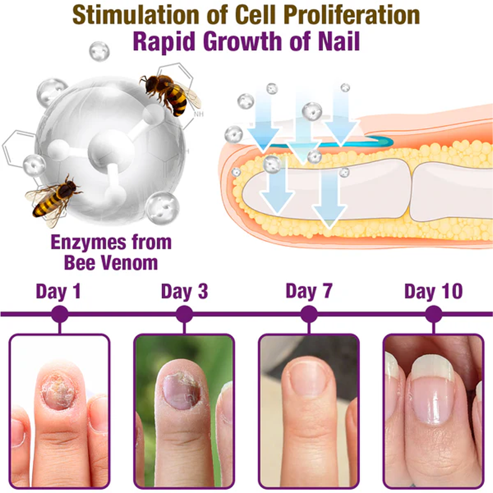 flysmus™ FungiFres Bienengift Nagelbehandlungsserum